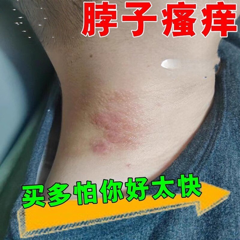 神经/性皮/痒顽固无激诊/湿止诊/湿止去慢性单纯性软膏痒