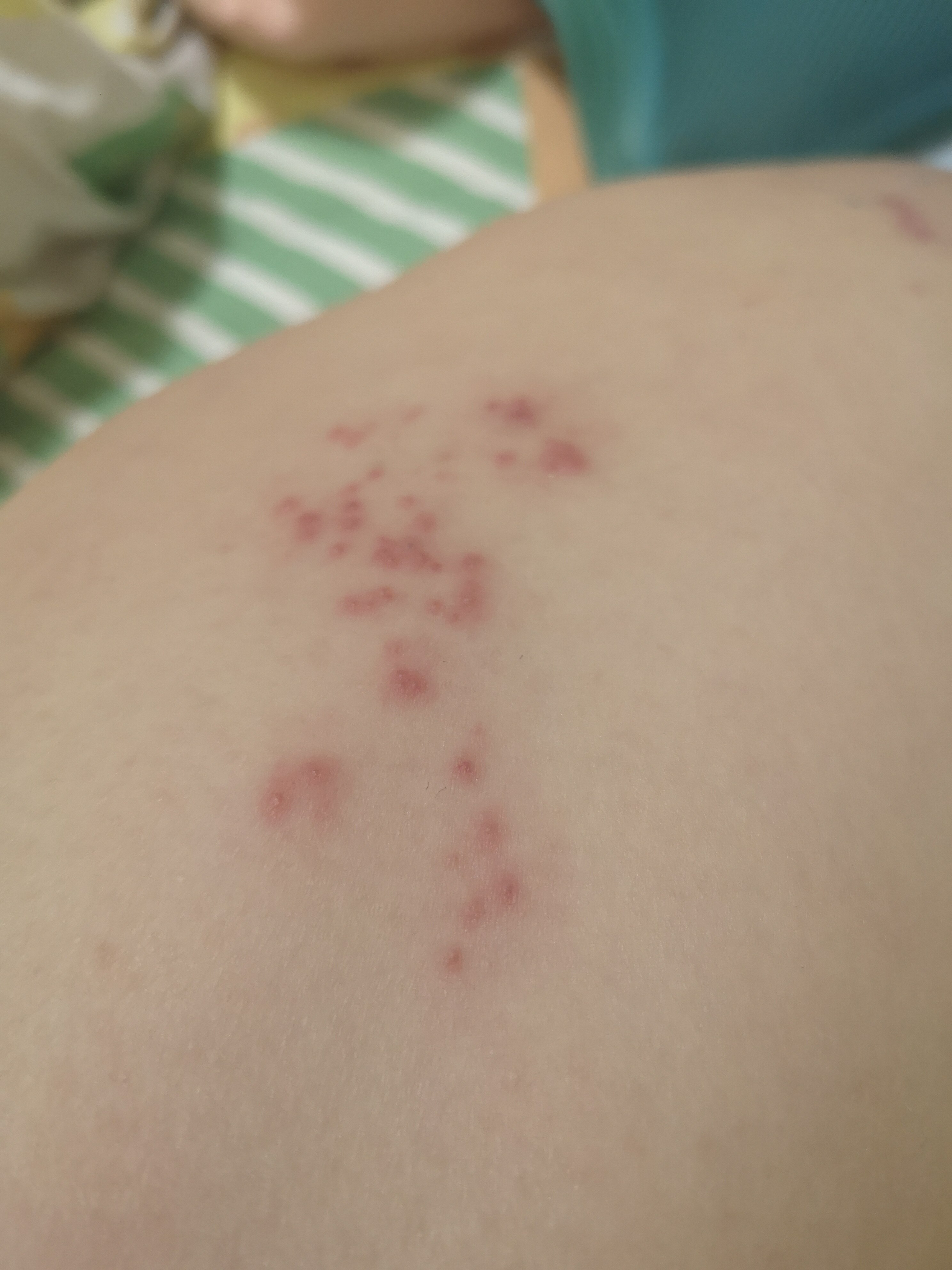 身上起红疙瘩痒牛皮癣铍特舒苗舒宁皮炎清药膏抑菌止痒宝宝小儿膏