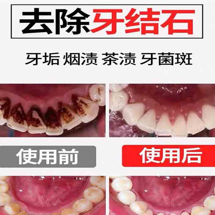 牙石去除剂家用牙结石去除器超声波去除牙垢牙结石清理器洗牙器牙