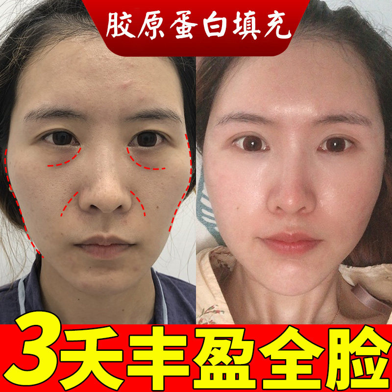胶原蛋白填充粉脸部面部去泪沟法令纹凹陷不回落脂肪丰额头精华液