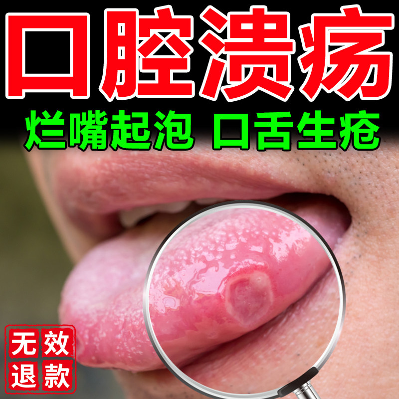 口腔溃疡专用膏药贴复发性口舌生疮儿童口腔溃疡散凝胶喷剂