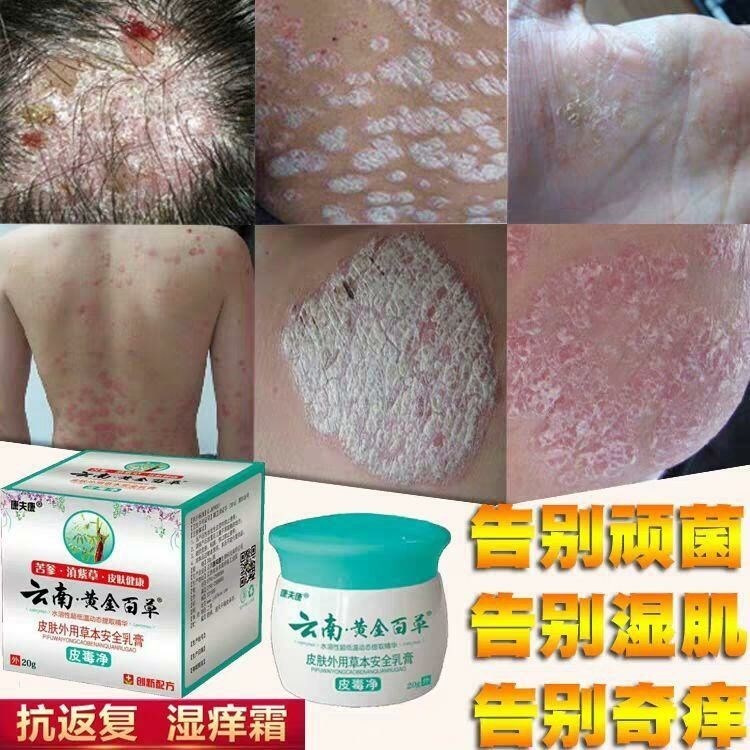 银屑湿疹止痒去根皮肤病专用头皮瘙痒外用癣藓药膏