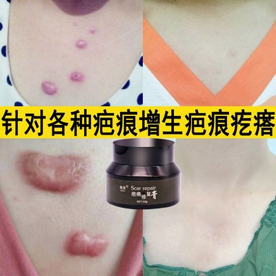 疤痕增生凸起软化去除瘢体