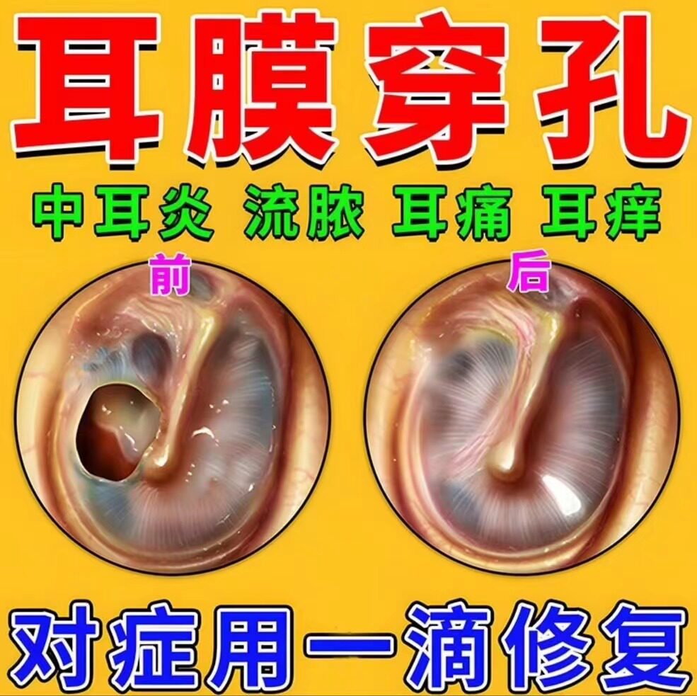 耳膜穿孔修复中耳炎耳聋耳鸣滴耳液外耳道湿疹流脓耳闷听不清痒疼