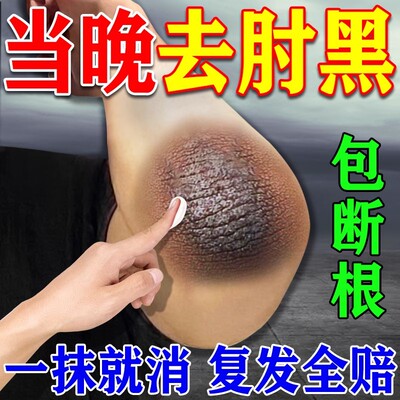 胳膊肘去黑皮肤黑色素沉淀去除死皮手肘关节黑磨砂膏美白变白神器