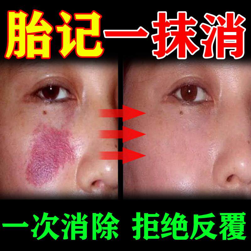 胎记去除神器太田痔淡化咖啡斑黑色素脸部褐色沉淀祛//斑膏