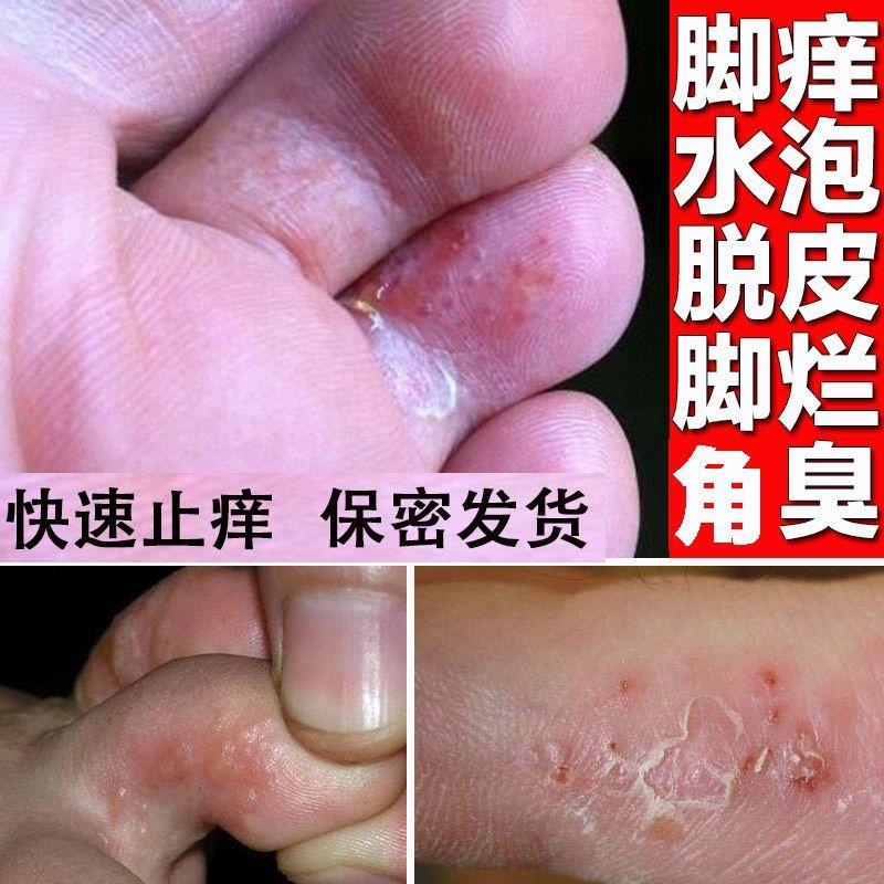 苗医生除脚臭脚痒烂脚丫手上脚上长水泡痒脱皮止痒.膏皮肤瘙.