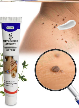 highquality Warts Remover Ointment Wart Treatment Cream Skin