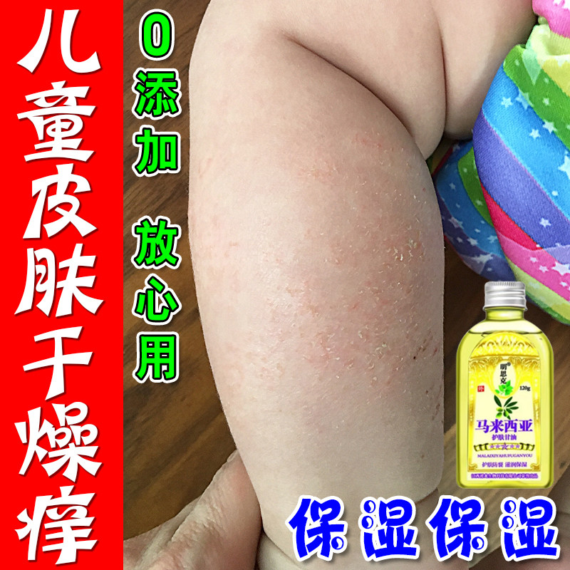 皮肤干燥起皮身体油马来西亚护肤甘油鱼鳞皮润肤乳液全身干燥皮肤