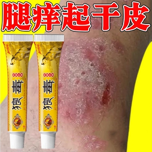 狼毒快速不痒膏小腿痒特痒外用全身皮肤手脚干痒小腿起干皮身上红