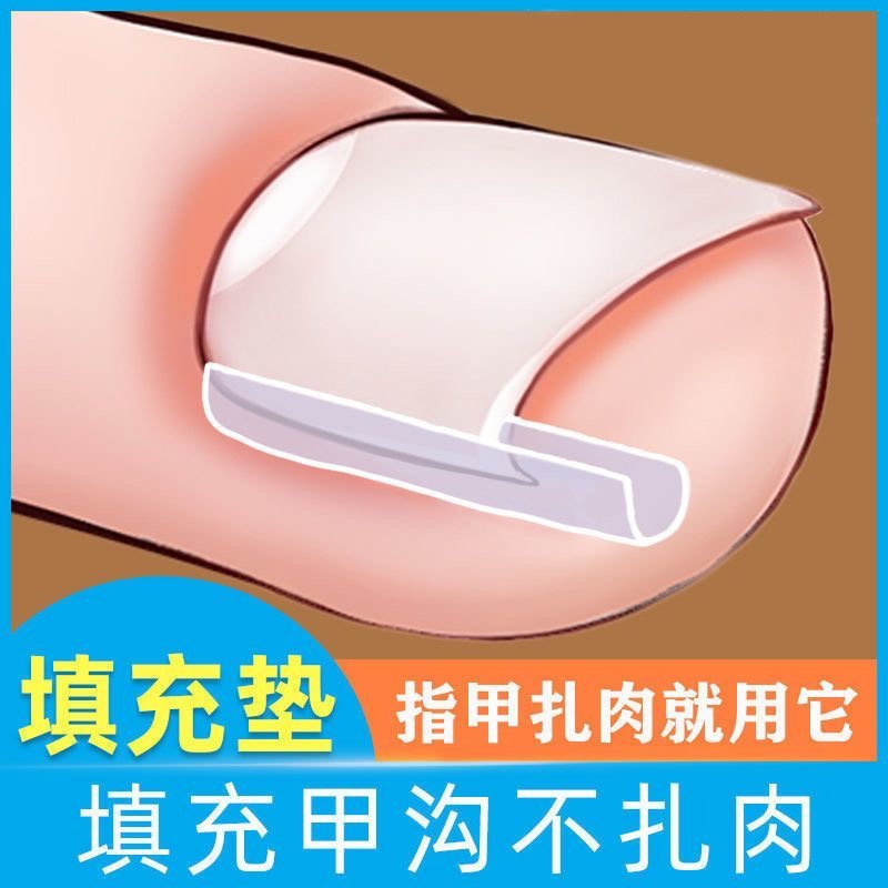 甲沟矫正神器指甲嵌甲专用填充隔离垫片脚趾甲往肉里长纠正甲贴