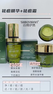 祛痘淡印2件套精华液30ml+面霜30g修复青春痘熬夜痘姨妈痘吃辣痘