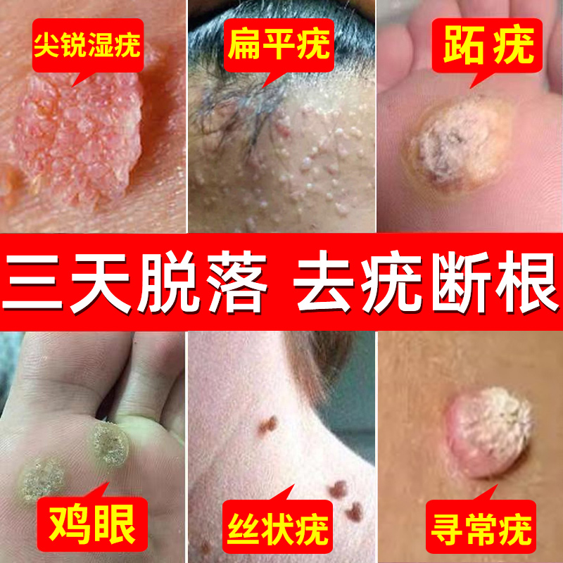 扁平疣去除有—抹灵去疣药水点痣药膏去脖子上长去尤瘊小肉粒鸡眼