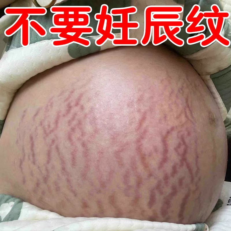 妊辰纹消除去妊娠紧致肚皮生长肥胖纹专用遮挡淡化产后紧致修复霜