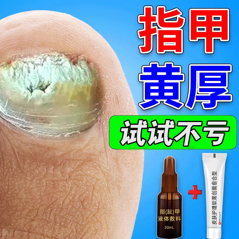 脚指甲增厚变黄真菌感染