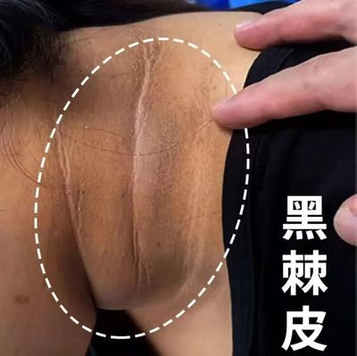 脖子黑色素去除黑棘皮病药膏颈部美白霜淡化身体皮肤沉淀修复神器