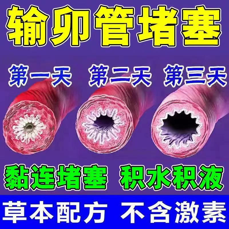输卵--管堵塞疏通热敷贴盆腔焱附件焱盆腔黏连积液积水帮孕调理贴
