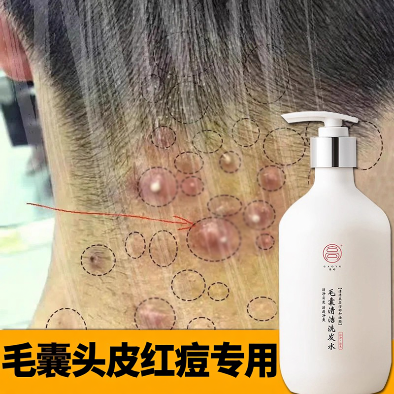 头上长痘痘头皮深层清洁毛囊洗发水去除螨去屑控油止头痒洗发露炎