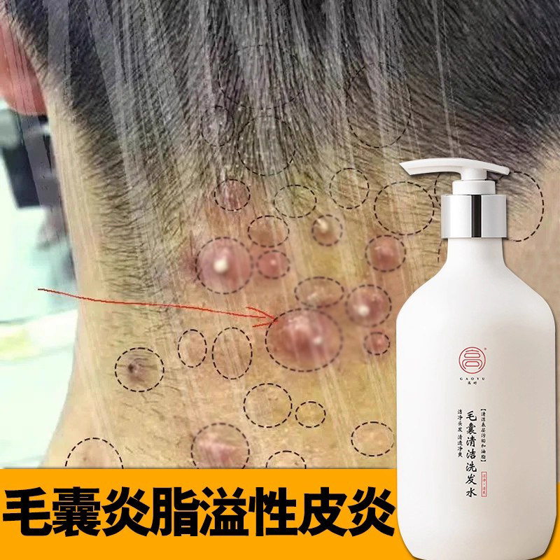 高妤治头皮长疙瘩毛囊炎洗发水