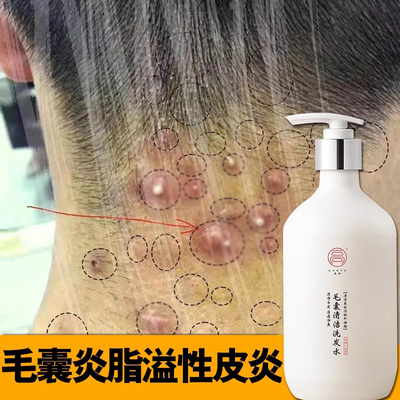 高妤治头皮长疙瘩毛囊炎洗发水