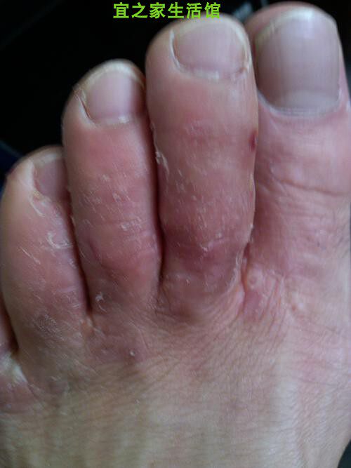 脚后跟痒脚气益夫净苗药癣王草本药膏苗癣王软膏皮肤外用抑菌止痒