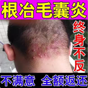 毛囊炎膏治疗头皮毛囊炎专用头部脖子前胸后背马拉色菌痘痘的膏药