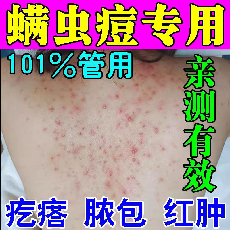 螨虫止痒效特膏药后背全身皮肤瘙痒除杀菌祛痘毛囊炎专用抑菌神器
