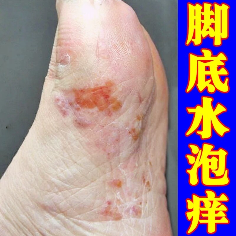 脚上起水泡脚底上长小水泡又痒又皮肤消毒护理（消）