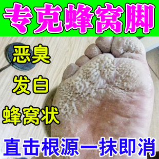 窝状角质松解症药脚底发白发臭发黄出汗糜烂性脚气脚脱皮真菌感染
