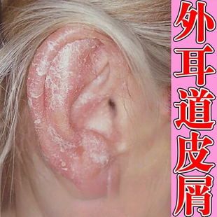 外耳道皮屑治疗耳朵痒里面发痒药耳朵痒干燥起皮掉屑脱皮专用软膏