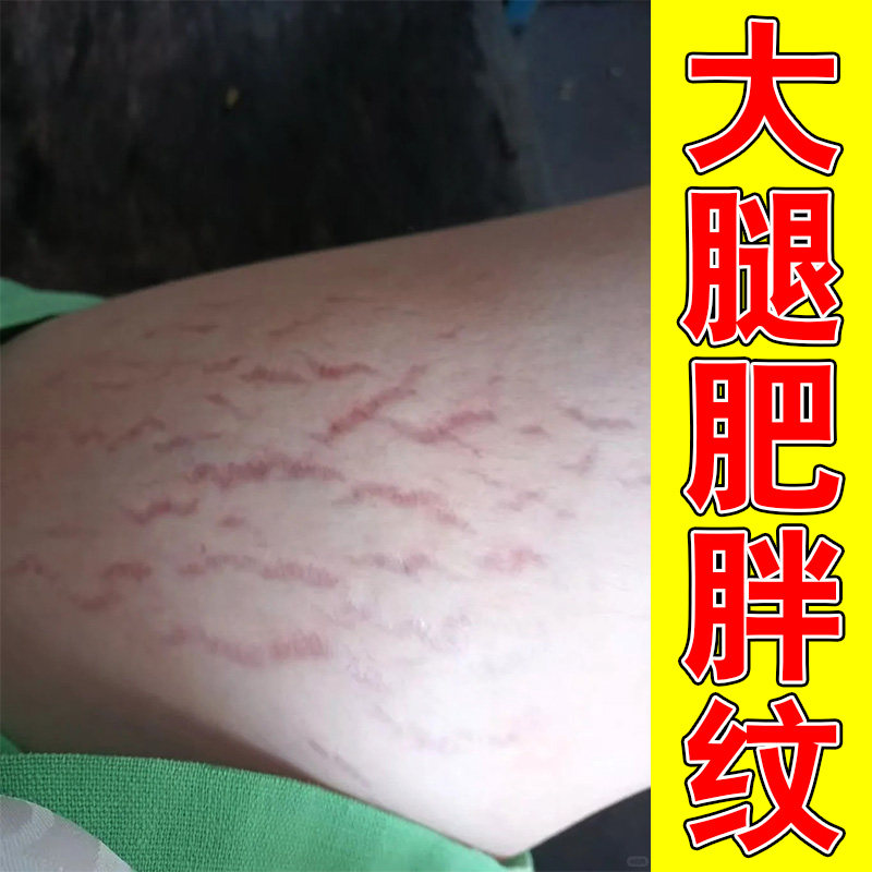 冶大腿生长肥胖纹肚子松弛产后妊皮肤消毒护理（消）