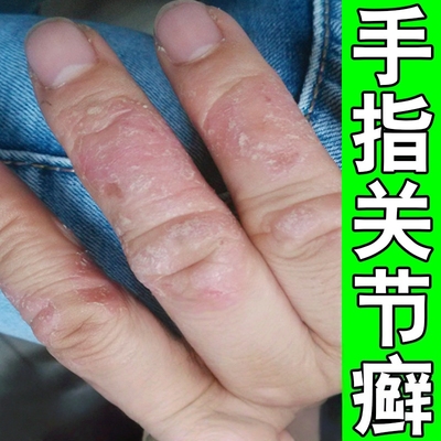 手指关节癣真菌感染开裂药手指关节长硬疙瘩伤癣脱皮干裂口手藓膏