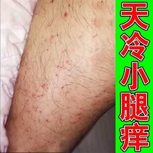 秋冬天冷腿痒腿上起红疙瘩长小红点腿部皮肤干燥起皮越挠越痒膏药