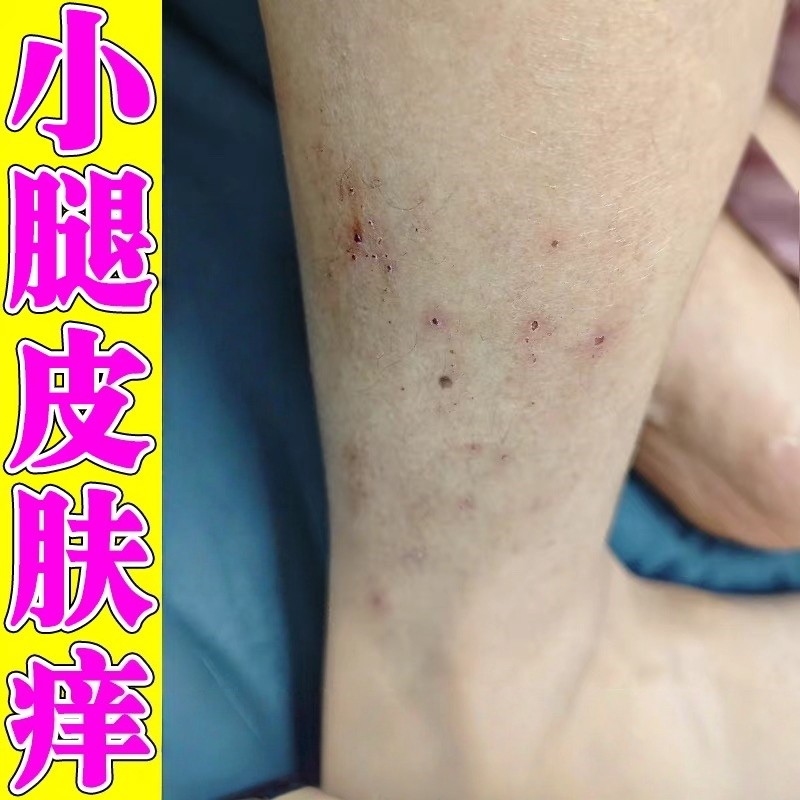 小腿皮肤痒起红疙瘩秋冬腿窝痒顽固腿上起小红点疙瘩过敏抑菌乳膏,保健用品,皮肤消毒护理（消）,淘宝优惠券,粉丝福利购,淘宝优惠卷