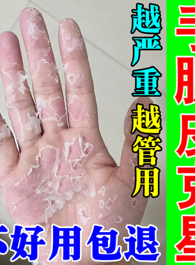 手足脱皮严重脱皮专用真菌感染蜕皮手指手掌干燥起皮掉皮止痒药膏