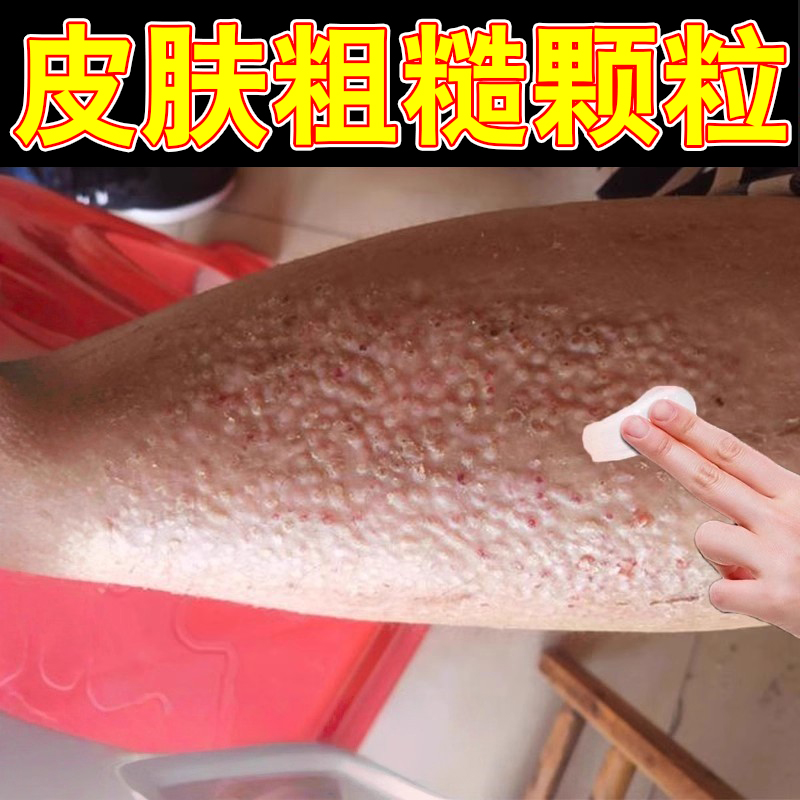 皮肤淀粉样变专用药治疗顽固皮藓小腿粗糙颗粒痒顽固性抑菌膏
