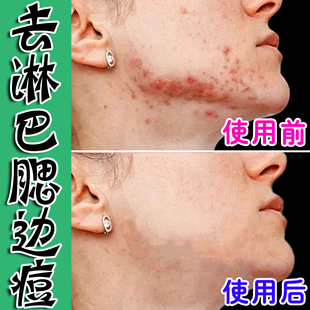 去淋巴腮边长痘膏下巴痘痘淋巴长痘腮边长痘硬块痘痤疮青春痘乳膏