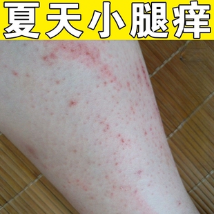 夏天天热小腿皮肤出汗发痒换季腿上起红疙瘩小红点浑身红痒修复膏