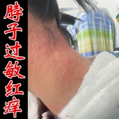 脖子红痒颈部长红点红疙瘩出汗痒痒皮肤过敏专药用皮湿炎疹外用膏