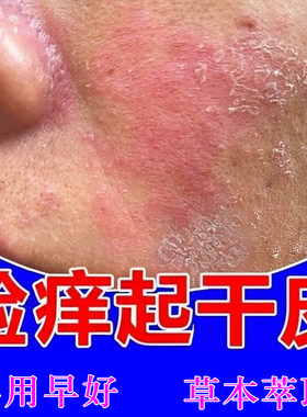 脸上发痒起干皮脸部皮肤干燥粗糙皮肤过敏红肿发痒草本修护乳膏
