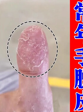 手脱皮严重脱皮专用手干裂干燥粗糙蜕皮真菌感染手指起皮掉皮药膏