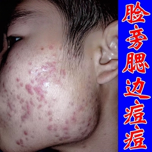 去淋巴腮边长痘额头下巴脸颊脖子长痘痘痤疮红肿硬块痘外用修复膏