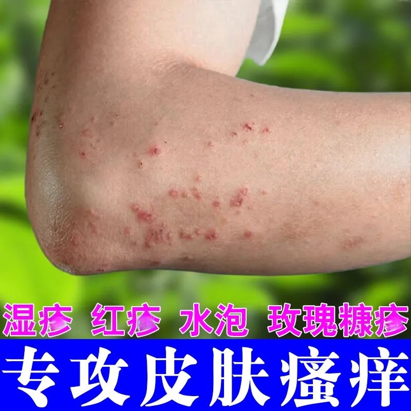 身上起红疙瘩痒长痘痘前胸后背头上起疙瘩专治过敏性皮肤痒的膏药