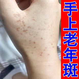 手上老年斑强力去除手部祛斑手背晒黑斑黑色素沉淀祛淡斑修复斑霜