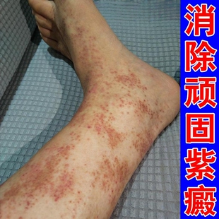 紫癜外用药腿部色素沉淀治疗皮下出血红点紫斑老年性皮痒专用膏药