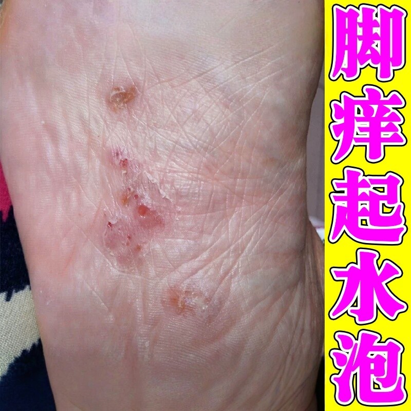 水泡型脚痒脚底起小水泡又痒又脱皮治脚心痒烂脚丫止痒杀菌修复药