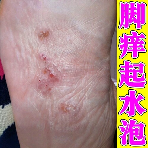 水泡型脚痒脚底起小水泡又痒又脱皮治脚心痒烂脚丫止痒杀菌修复药