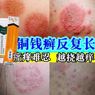 派瑞松曲安奈德益康唑乳膏15g体癣膏治脚气的药湿疹止痒臭汗脚膏