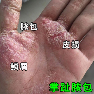 掌趾脓疱病专用膏掌跖脓包角化症手脚掌脓包脱皮干裂疼痛痒拨毒膏