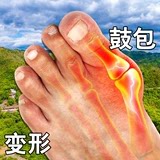 拇指外翻膏药贴脚趾矫正器大脚骨脚趾重叠痛关节畸形拇囊炎矫正贴